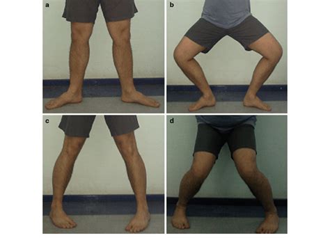 medial meniscus tear diagnostic test|squat test for meniscus tear.